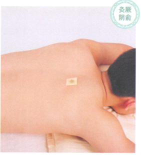 慢性支气管炎艾灸哪个部位图解