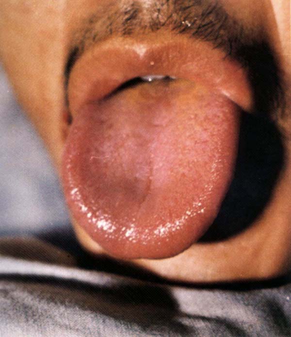 红舌黄白滑腻苔