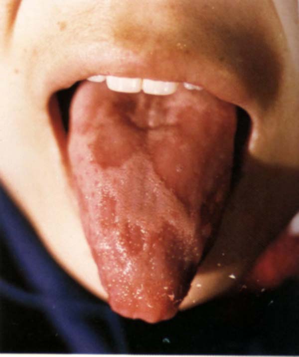 红舌花剥苔（地图舌）