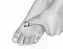 肩周炎按摩部位图解