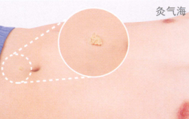 中暑艾灸哪个部位图解