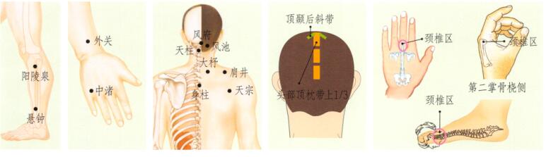 颈椎病刮痧部位图解