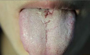 几种异常舌苔预示疾病