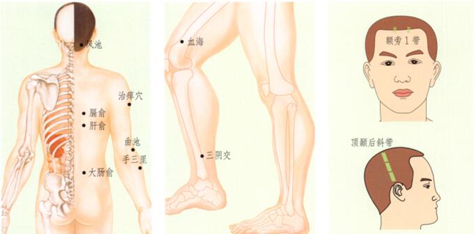 荨麻疹刮痧部位图解