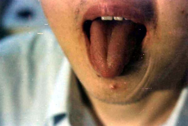 中医望皮肤之火疖，毛囊炎