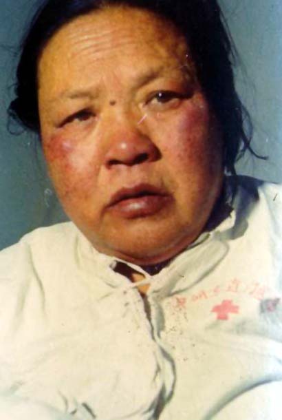 中医望色之颧唇紫绀