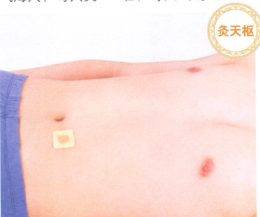 便秘艾灸哪个部位图解