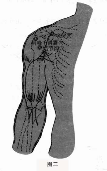 肩周炎钩针疗法