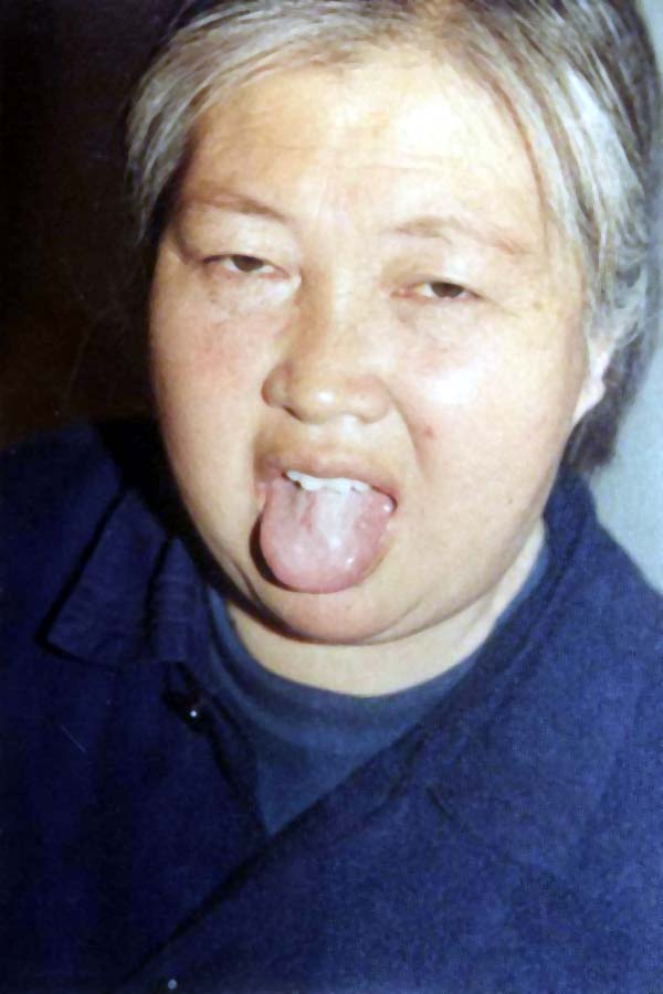 中医望皮肤之面色淡黄，阳黄