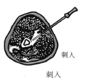 小针刀的进刀方法