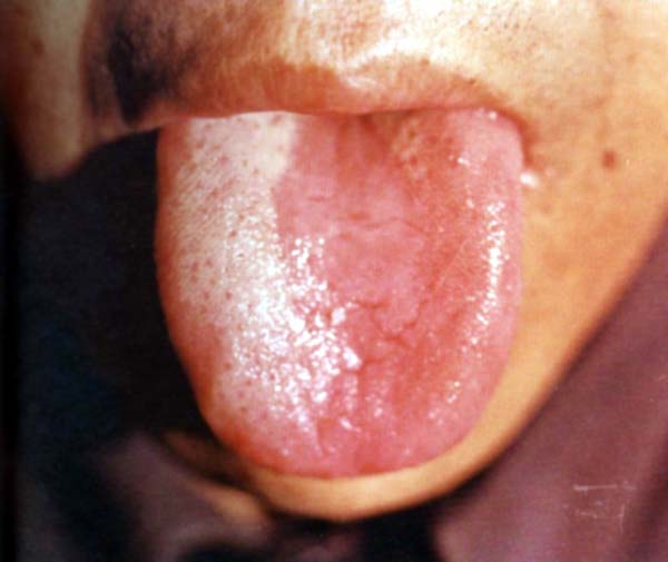 淡红舌偏白滑苔1