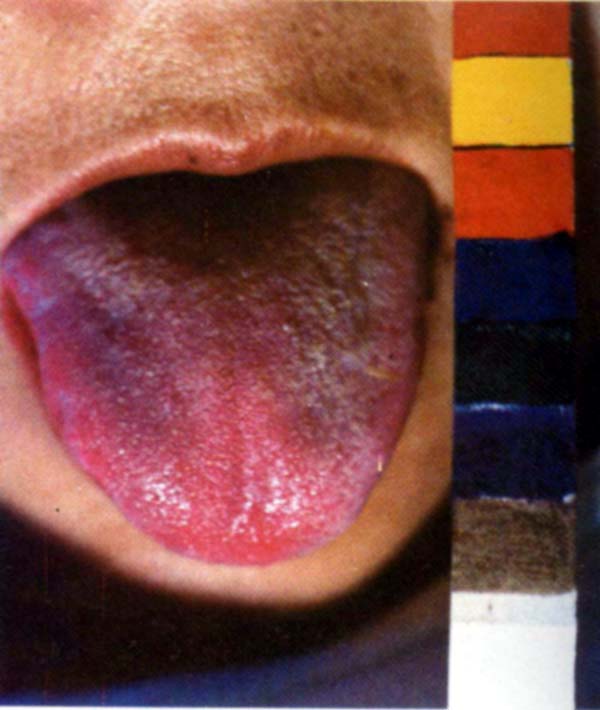 绛紫苍老舌透明根灰苔