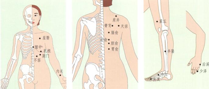 急性乳腺炎刮痧部位图解