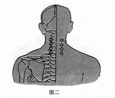 颈椎病钩针疗法
