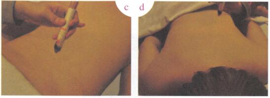 祛除黄褐斑艾灸哪个部位图解