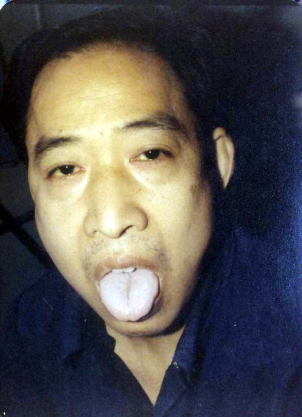 中医望目之白睛淡黄