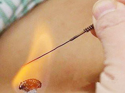 火针配合艾灸治疗带状疱疹后遗神经痛