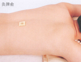 斑秃艾灸哪个部位图解