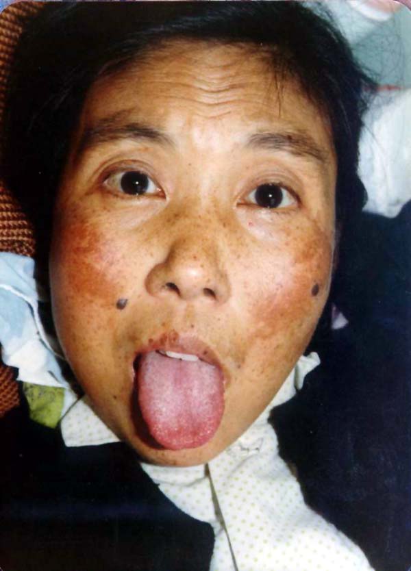 中医望皮肤之黑斑黑痣