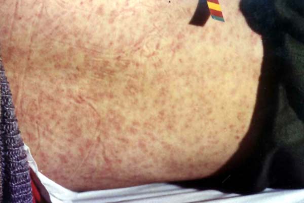 中医望皮肤之腰背麻疹