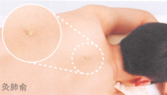 肺结核艾灸哪个部位图解