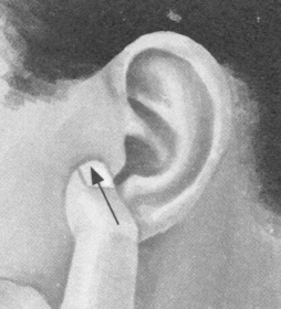 风湿病按摩部位图解