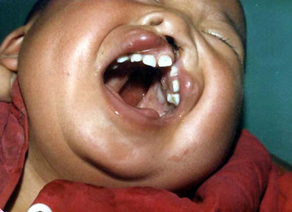 中医望口与唇之兔唇