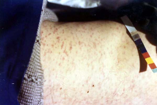 中医望皮肤之麻疹胸