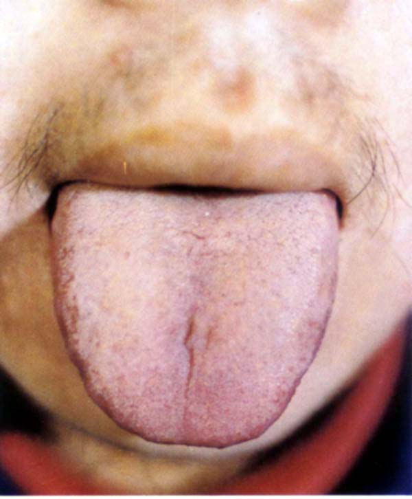 淡紫齿痕舌淡黄腻苔