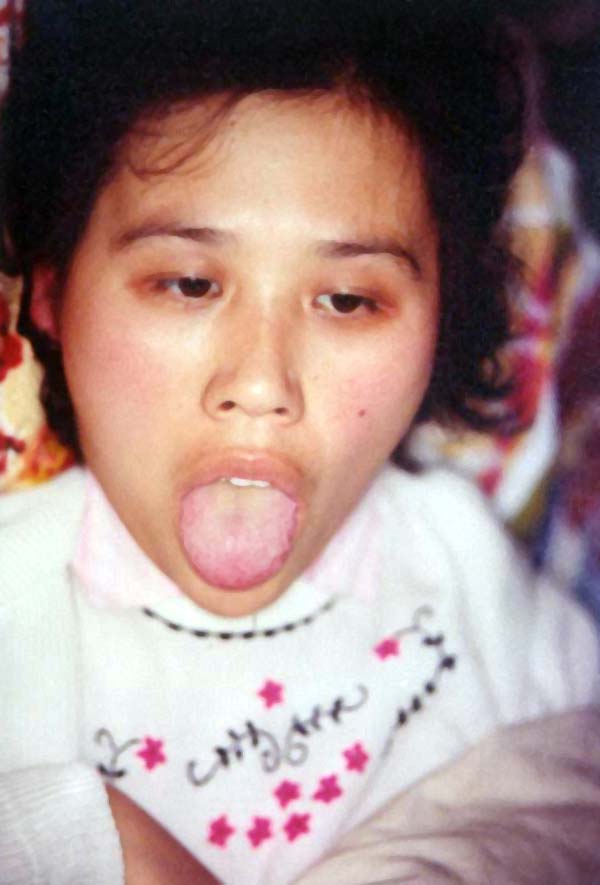 中医望神之面白颧红