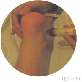 祛除黄褐斑艾灸哪个部位图解