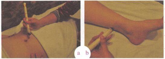 祛除黄褐斑艾灸哪个部位图解