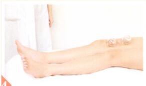 瘦身降脂拔罐部位图解