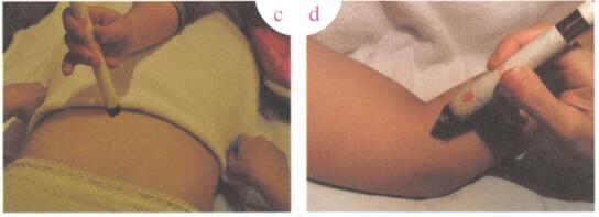 祛除雀斑艾灸哪个部位图解