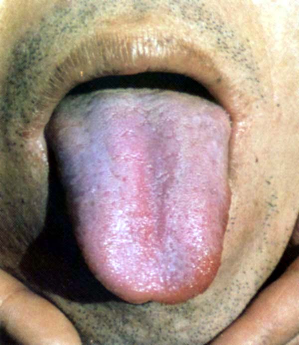 淡红紫斑舌类剥苔