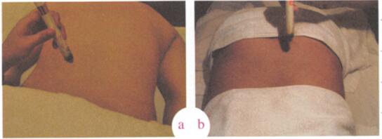 祛除黄褐斑艾灸哪个部位图解