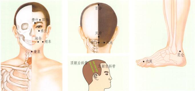 中风后遗症刮痧部位图解