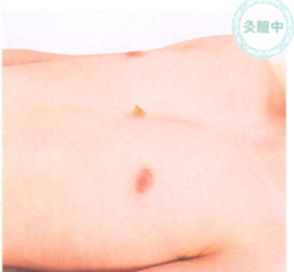 冠心病艾灸哪个部位图解