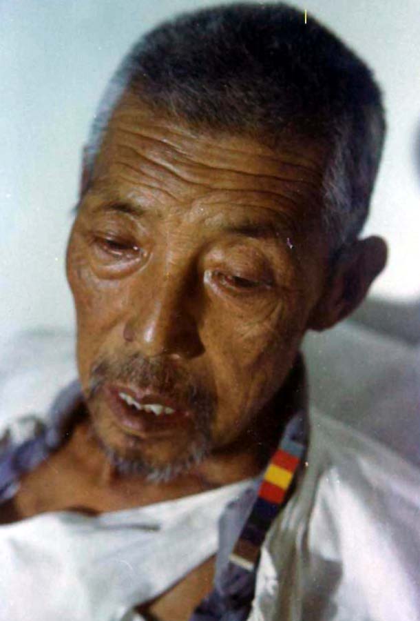 中医望色之面黑而浊