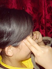 偏头痛的针灸治疗