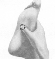 高脂血症按摩部位图解