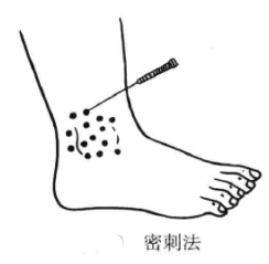 火针疗法的进针方法