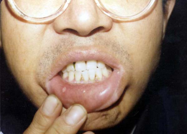 中医望口与唇之口糜