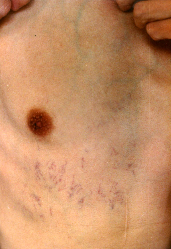 中医望肢体之胸腹青筋血缕