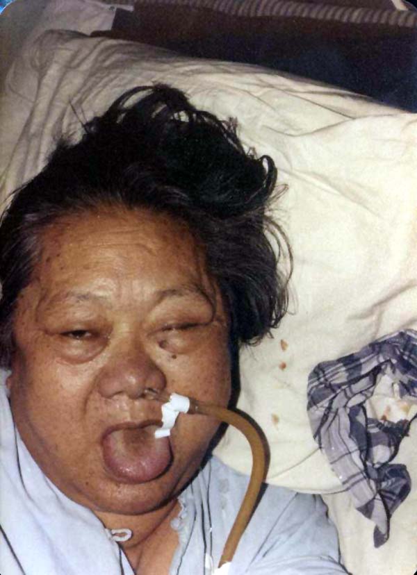 中医望目之目窠肿