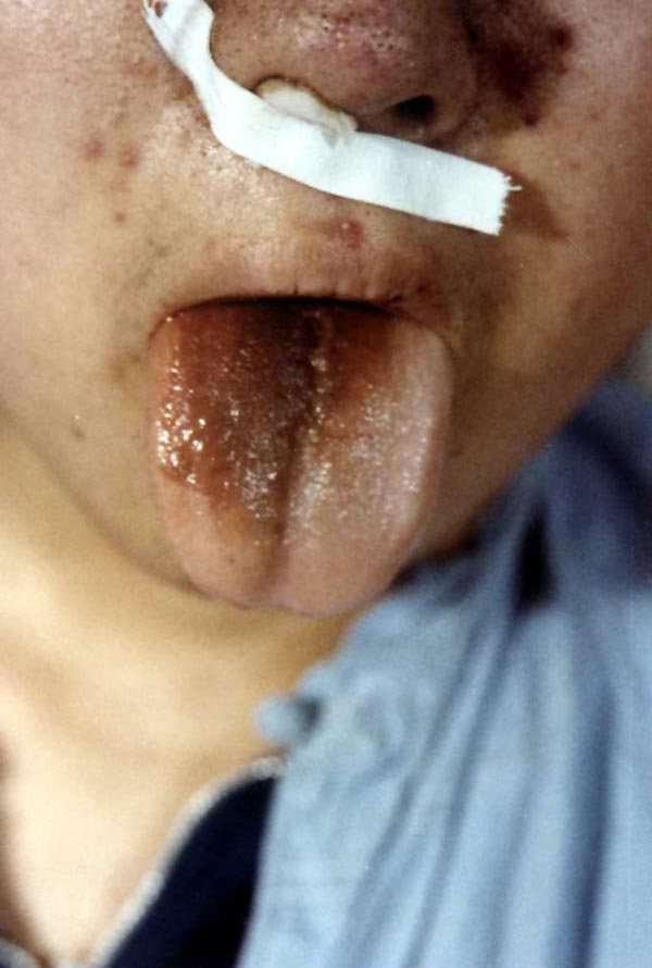 中医望皮肤之痤疮