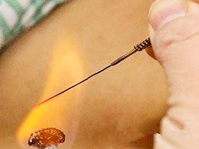 火针疗法–独具特色中医针法