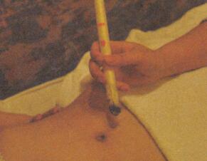 小儿胀气艾灸哪个部位图解