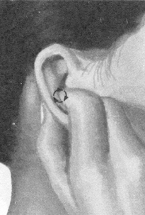 糖尿病按摩部位图解