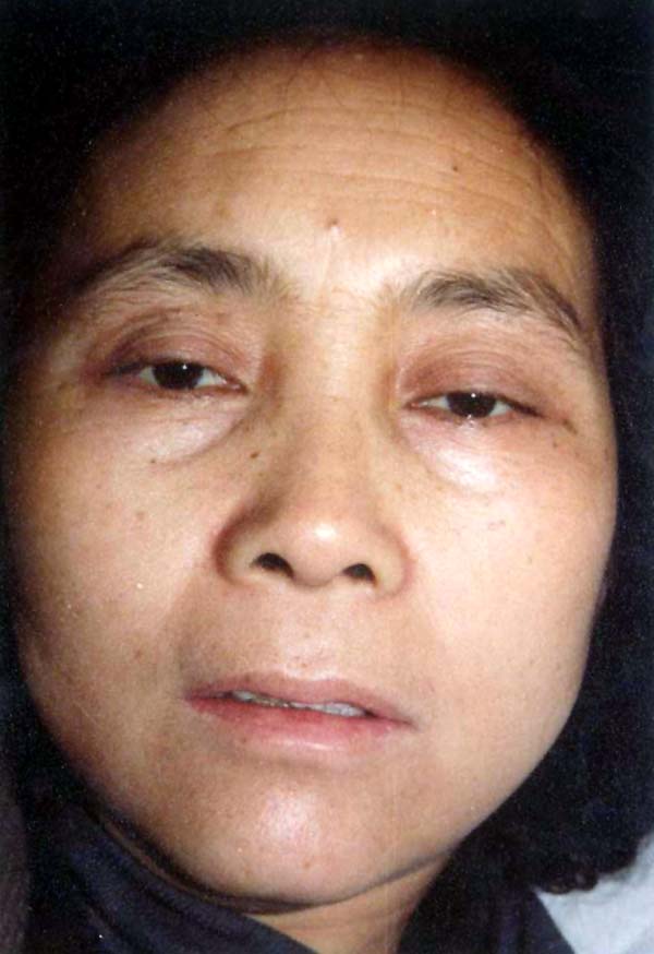 中医望神之虚证少神1